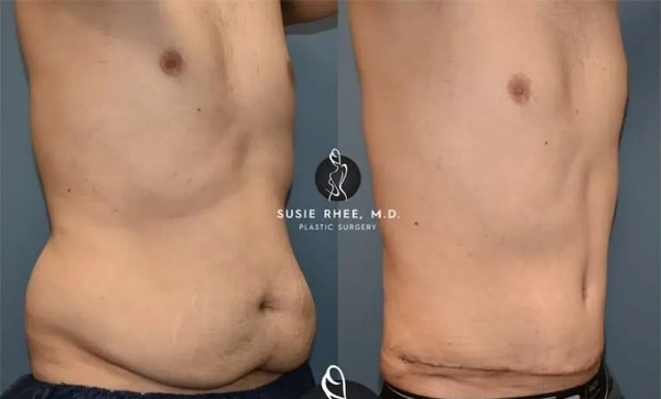 Real patient results before and after plastic surgery results in Long Island, NY, performed by Dr. Sotirios Papafragkou.