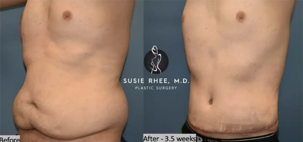 Real patient results before and after plastic surgery results in Long Island, NY, performed by Dr. Sotirios Papafragkou.