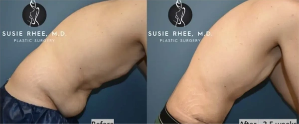 Real patient results before and after plastic surgery results in Long Island, NY, performed by Dr. Sotirios Papafragkou.