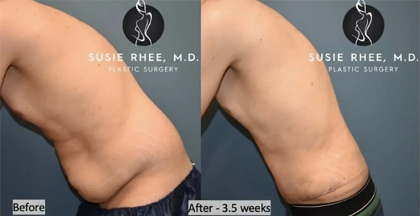 Real patient results before and after plastic surgery results in Long Island, NY, performed by Dr. Sotirios Papafragkou.