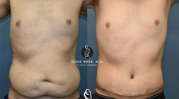 Real patient results before and after plastic surgery results in Long Island, NY, performed by Dr. Sotirios Papafragkou.