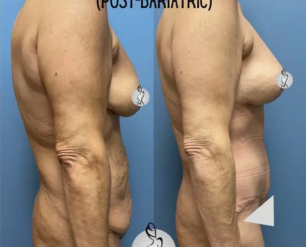 Real patient results before and after plastic surgery results in Long Island, NY, performed by Dr. Sotirios Papafragkou.