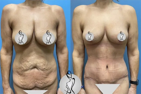 Real patient results before and after plastic surgery results in Long Island, NY, performed by Dr. Sotirios Papafragkou.