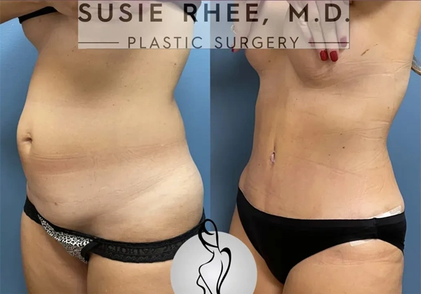 Real patient results before and after plastic surgery results in Long Island, NY, performed by Dr. Sotirios Papafragkou.
