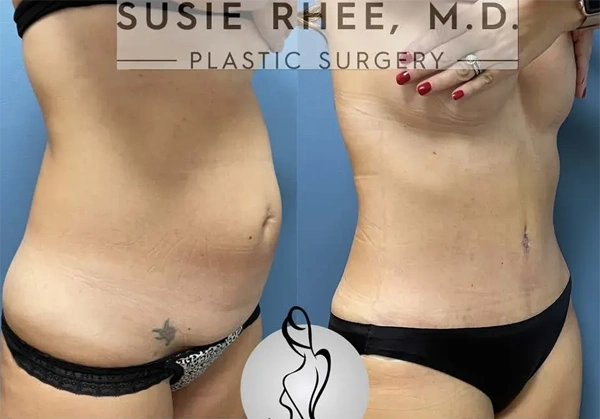 Real patient results before and after plastic surgery results in Long Island, NY, performed by Dr. Sotirios Papafragkou.