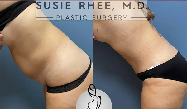 Real patient results before and after plastic surgery results in Long Island, NY, performed by Dr. Sotirios Papafragkou.