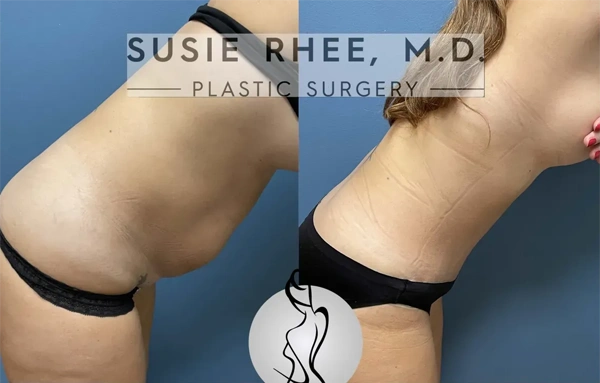 Real patient results before and after plastic surgery results in Long Island, NY, performed by Dr. Sotirios Papafragkou.