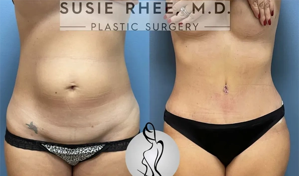 Real patient results before and after plastic surgery results in Long Island, NY, performed by Dr. Sotirios Papafragkou.