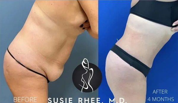 Real patient results before and after plastic surgery results in Long Island, NY, performed by Dr. Sotirios Papafragkou.