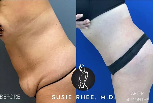 Real patient results before and after plastic surgery results in Long Island, NY, performed by Dr. Sotirios Papafragkou.