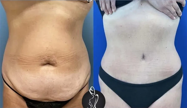 Real patient results before and after plastic surgery results in Long Island, NY, performed by Dr. Sotirios Papafragkou.