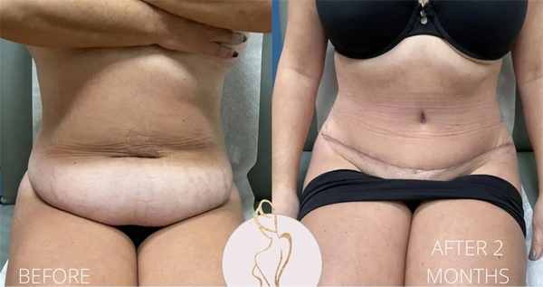 Real patient results before and after plastic surgery results in Long Island, NY, performed by Dr. Sotirios Papafragkou.