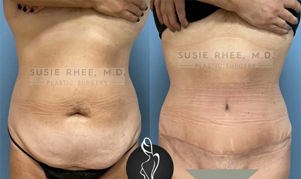Real patient results before and after plastic surgery results in Long Island, NY, performed by Dr. Sotirios Papafragkou.