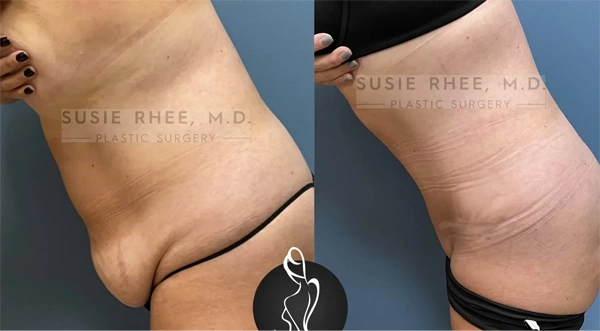 Real patient results before and after plastic surgery results in Long Island, NY, performed by Dr. Sotirios Papafragkou.