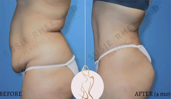 Real patient results before and after plastic surgery results in Long Island, NY, performed by Dr. Sotirios Papafragkou.