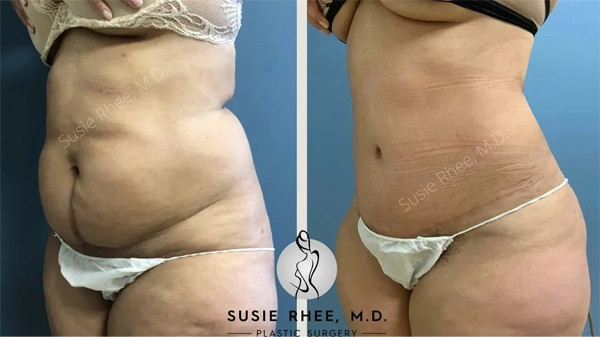 Real patient results before and after plastic surgery results in Long Island, NY, performed by Dr. Sotirios Papafragkou.