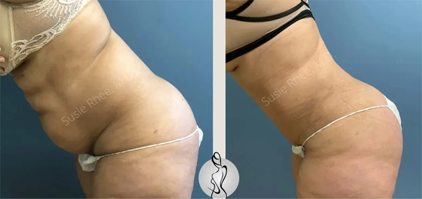 Real patient results before and after plastic surgery results in Long Island, NY, performed by Dr. Sotirios Papafragkou.