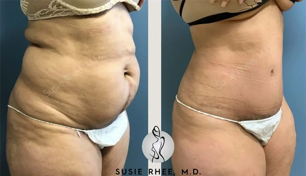 Real patient results before and after plastic surgery results in Long Island, NY, performed by Dr. Sotirios Papafragkou.