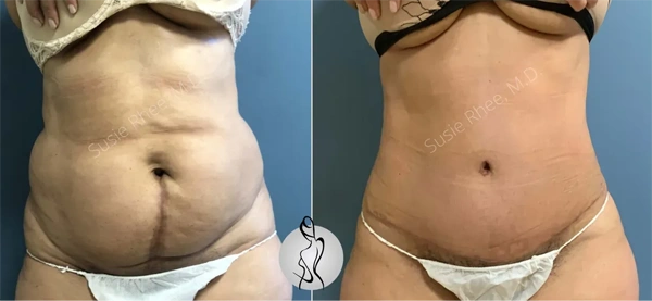 Real patient results before and after plastic surgery results in Long Island, NY, performed by Dr. Sotirios Papafragkou.