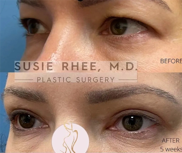 Real patient results before and after plastic surgery results in Long Island, NY, performed by Dr. Sotirios Papafragkou.