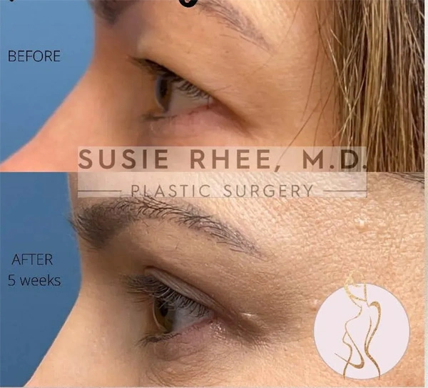 Real patient results before and after plastic surgery results in Long Island, NY, performed by Dr. Sotirios Papafragkou.
