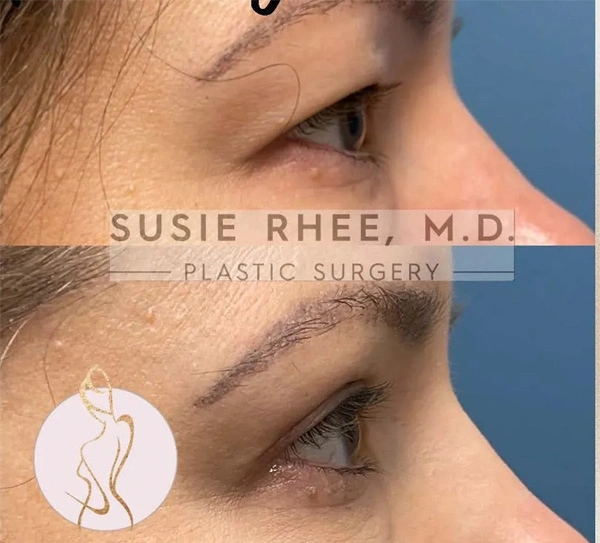 Real patient results before and after plastic surgery results in Long Island, NY, performed by Dr. Sotirios Papafragkou.