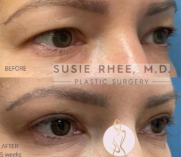 Real patient results before and after plastic surgery results in Long Island, NY, performed by Dr. Sotirios Papafragkou.