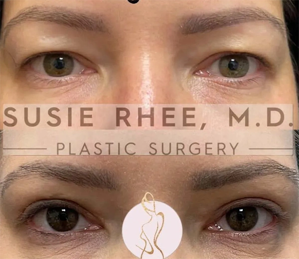 Real patient results before and after plastic surgery results in Long Island, NY, performed by Dr. Sotirios Papafragkou.