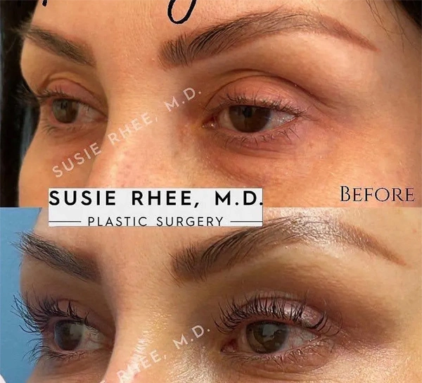 Real patient results before and after plastic surgery results in Long Island, NY, performed by Dr. Sotirios Papafragkou.