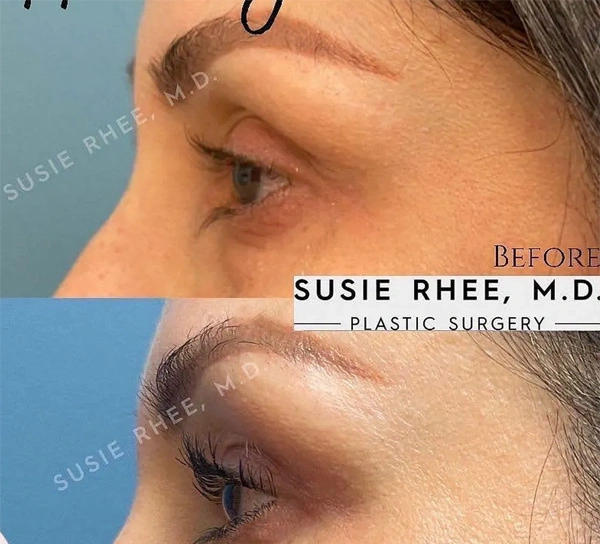 Real patient results before and after plastic surgery results in Long Island, NY, performed by Dr. Sotirios Papafragkou.