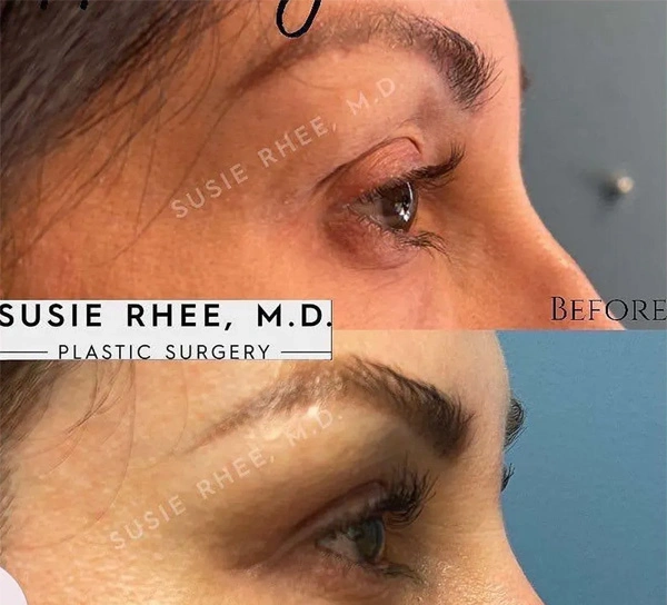 Real patient results before and after plastic surgery results in Long Island, NY, performed by Dr. Sotirios Papafragkou.
