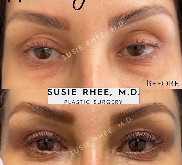 Real patient results before and after plastic surgery results in Long Island, NY, performed by Dr. Sotirios Papafragkou.