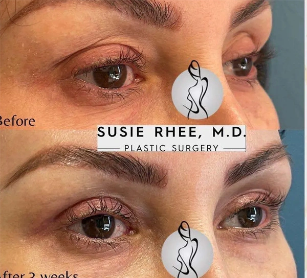 Real patient results before and after plastic surgery results in Long Island, NY, performed by Dr. Sotirios Papafragkou.