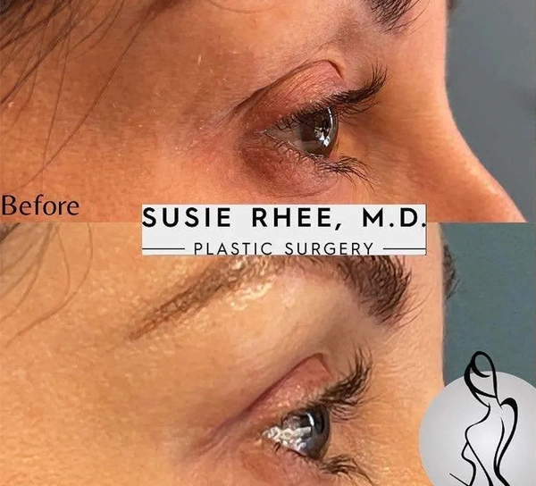 Real patient results before and after plastic surgery results in Long Island, NY, performed by Dr. Sotirios Papafragkou.