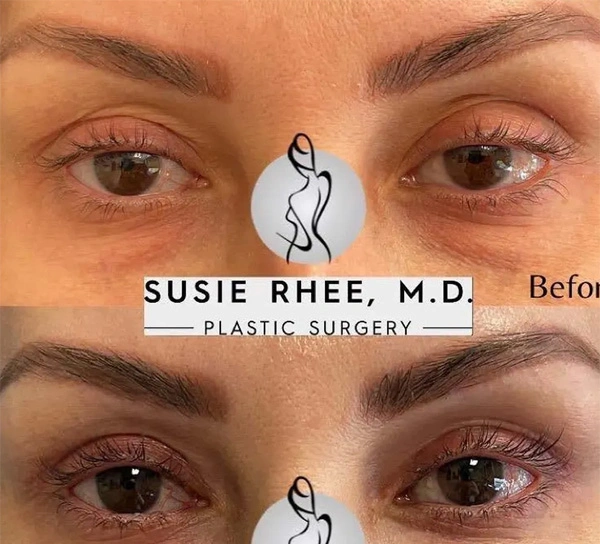 Real patient results before and after plastic surgery results in Long Island, NY, performed by Dr. Sotirios Papafragkou.