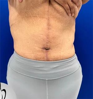 01-A-body-contouring-preview