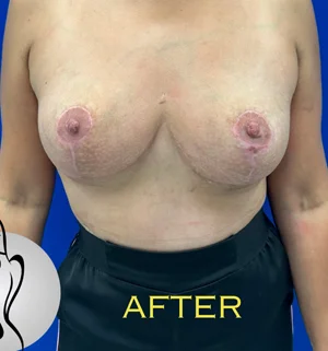 01-A-breast-revi-preview