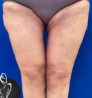 01-A-thigh-lift-preview