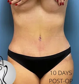 01-A-tummy-tuck-preview