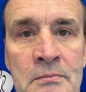 01-A-upper-eye-preview