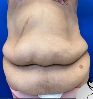 01-B-body-contouring-preview