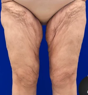 01-B-thigh-lift-preview