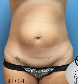 01-B-tummy-tuck-preview