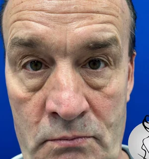 01-B-upper-eye-preview