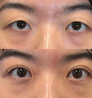 01-asian-eyelid-preview
