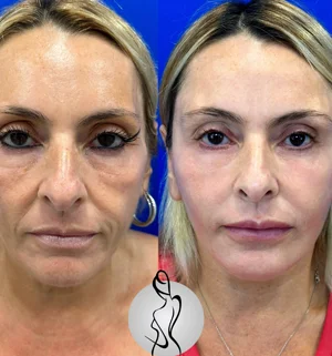 01-face-lift-preview