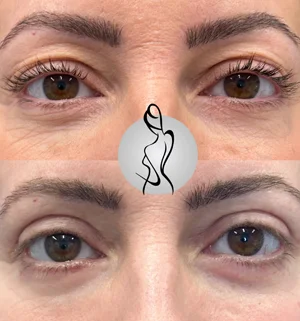 01-lower-eyelids-preview