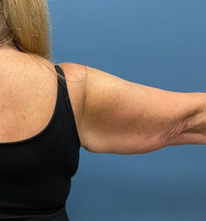 02-A-arm-lift-preview