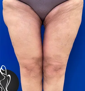 02-A-body-contouring-preview