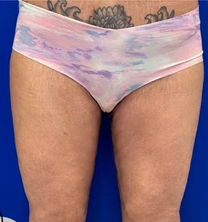 02-A-thigh-lift-preview